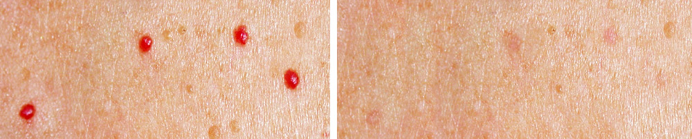 Blood Spot Removal Services Renew Skin Clinic