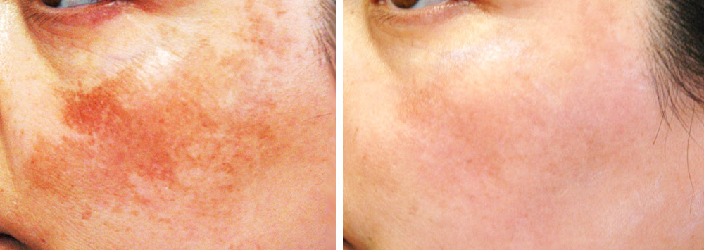 Sun spots, age spots, freckles Removed