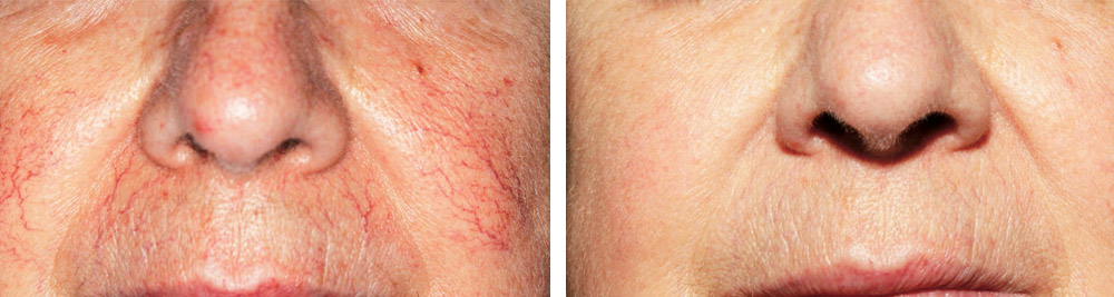 Thread Vein Treatment by Laser